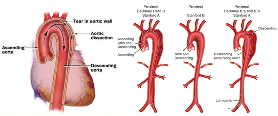 Aortic Dissections
