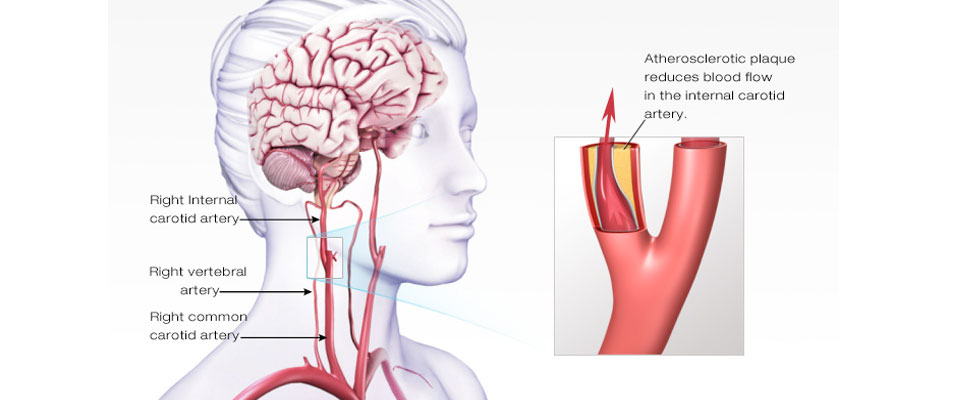 Strokes, Carotid Artery Disease